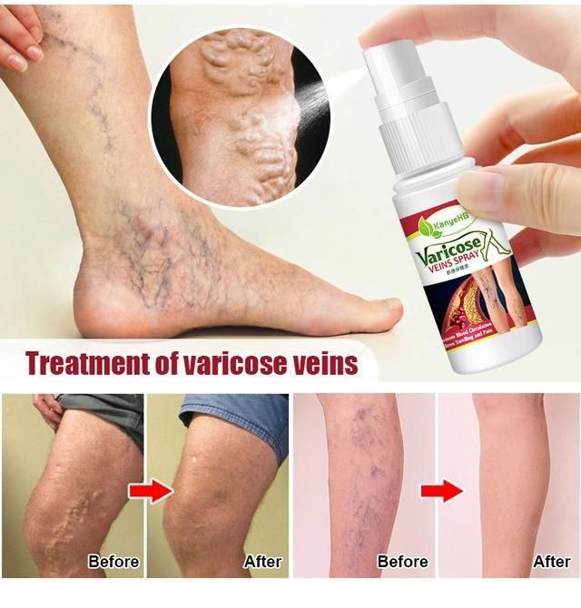 New Year New You - Varicose Veins Treatment Spray