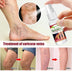 New Year New You - Varicose Veins Treatment Spray