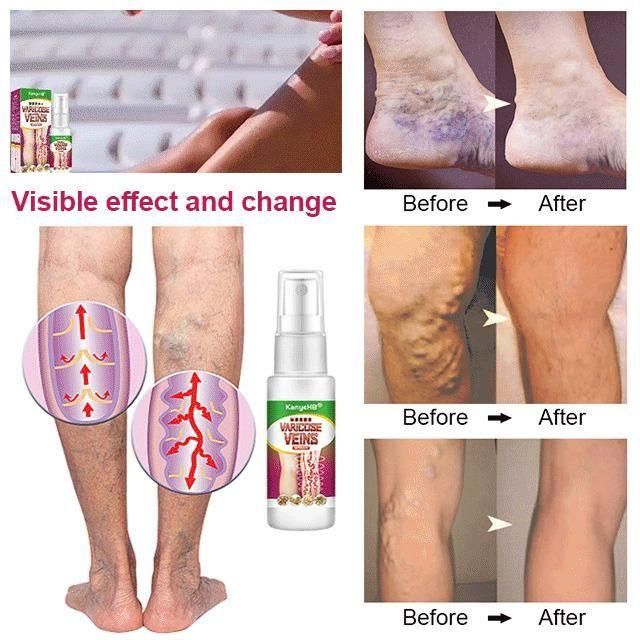 New Year New You - Varicose Veins Treatment Spray