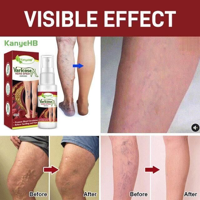 New Year New You - Varicose Veins Treatment Spray